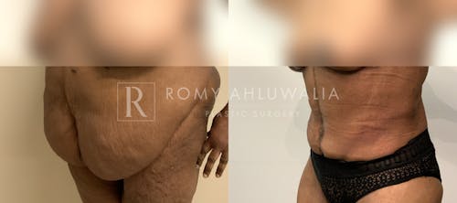 Before & After Result of Tummy Tuck Patient #46