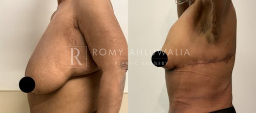 Before & After Result of Breast Reduction Patient #20