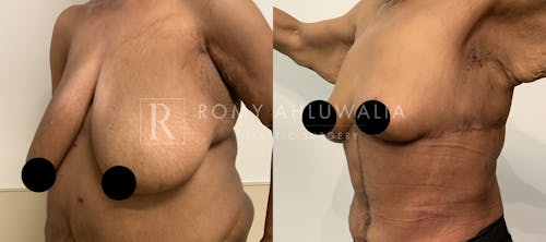 Before & After Result of Breast Reduction Patient #20