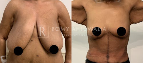 Before & After Result of Breast Reduction Patient #20