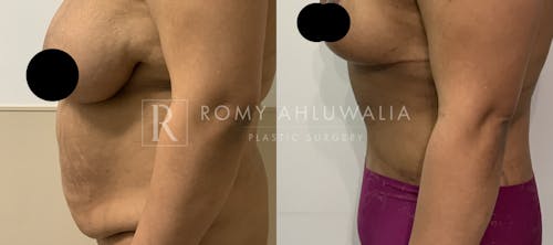 Before & After Result of Tummy Tuck Patient #47