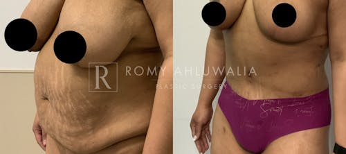 Before & After Result of Tummy Tuck Patient #47