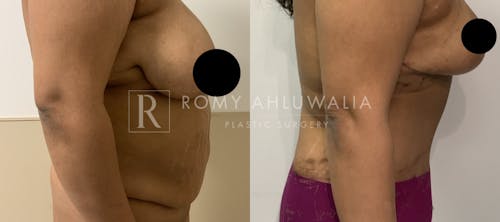 Before & After Result of Tummy Tuck Patient #47