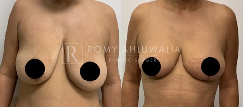 Before & After Result of Breast Reduction Patient #23