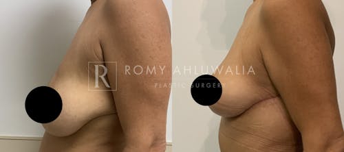 Before & After Result of Breast Reduction Patient #23