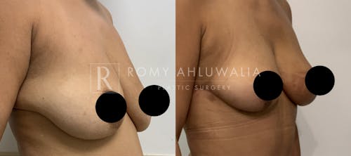 Before & After Result of Breast Reduction Patient #23