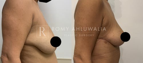 Before & After Result of Breast Reduction Patient #23