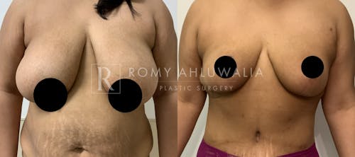 Before & After Result of Breast Reduction Patient #19