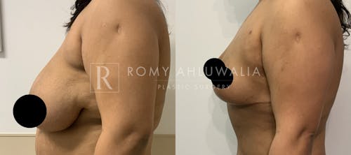 Before & After Result of Breast Reduction Patient #19
