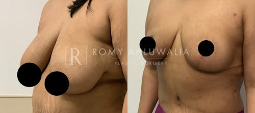 Before & After Result of Breast Reduction Patient #19