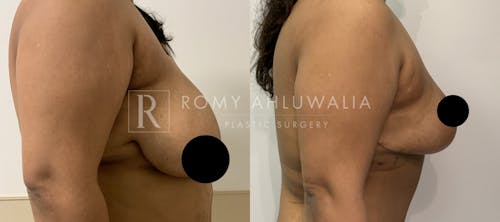 Before & After Result of Breast Reduction Patient #19