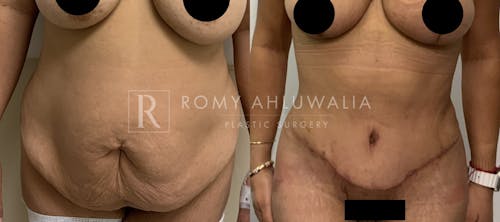 Before & After Result of Tummy Tuck Patient #7