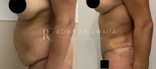 Before & After Result of Tummy Tuck Patient #7