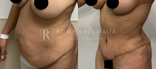 Before & After Result of Tummy Tuck Patient #7