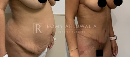 Before & After Result of Tummy Tuck Patient #7