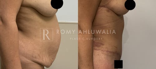 Before & After Result of Tummy Tuck Patient #7