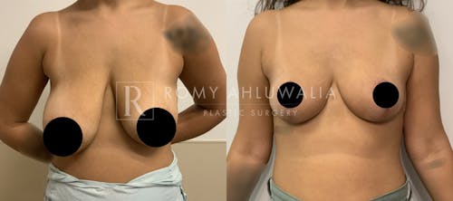 Before & After Result of Breast Reduction Patient #30