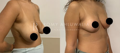 Before & After Result of Breast Reduction Patient #30