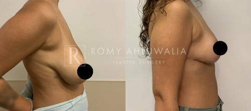 Before & After Result of Breast Reduction Patient #30