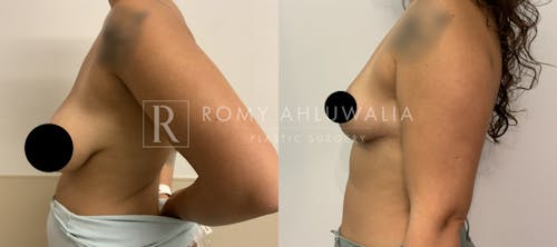 Before & After Result of Breast Reduction Patient #30