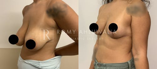 Before & After Result of Breast Reduction Patient #30