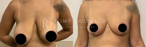 Before & After Result of Breast Asymmetry Correction Patient #2