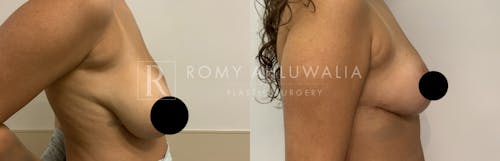 Before & After Result of Breast Asymmetry Correction Patient #2