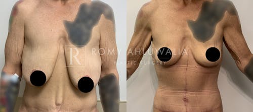 Before & After Result of Breast Reduction Patient #29