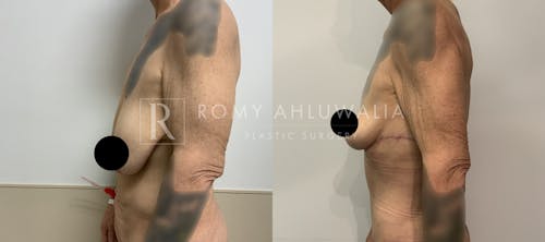 Before & After Result of Breast Reduction Patient #29