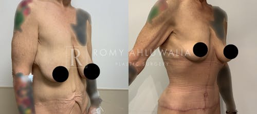 Before & After Result of Breast Reduction Patient #29