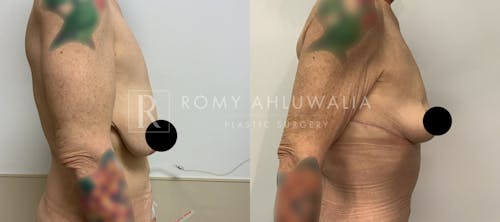Before & After Result of Breast Reduction Patient #29