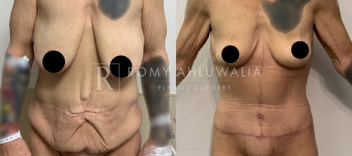 Before & After Result of Tummy Tuck Patient #48