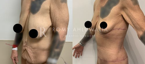 Before & After Result of Tummy Tuck Patient #48