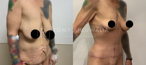 Before & After Result of Tummy Tuck Patient #48