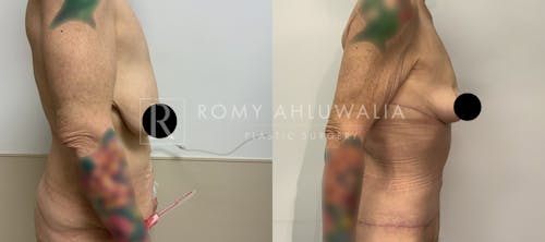 Before & After Result of Tummy Tuck Patient #48