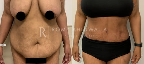 Before & After Result of Tummy Tuck Patient #49