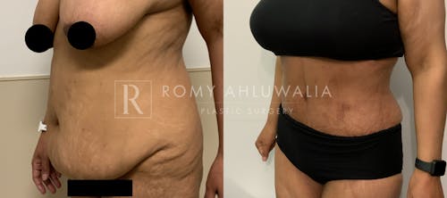 Before & After Result of Tummy Tuck Patient #49