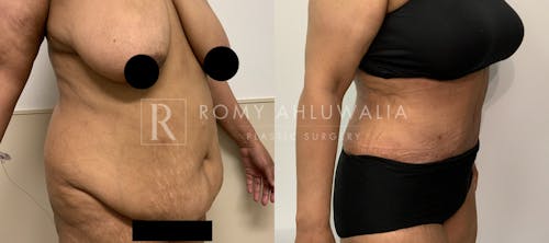 Before & After Result of Tummy Tuck Patient #49