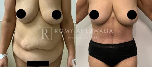 Before & After Result of Tummy Tuck Patient #50