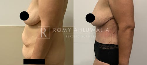 Before & After Result of Tummy Tuck Patient #50