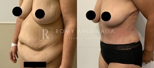 Before & After Result of Tummy Tuck Patient #50