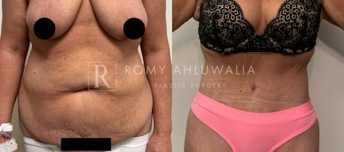 Before & After Result of Tummy Tuck Patient #2