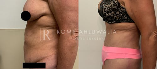 Before & After Result of Tummy Tuck Patient #2