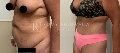 Before & After Result of Tummy Tuck Patient #2