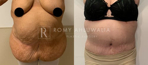 Before & After Result of Tummy Tuck Patient #51