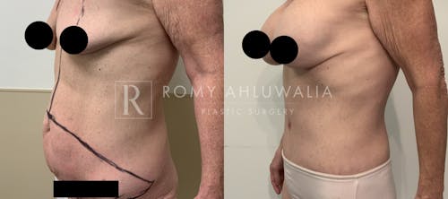 Before & After Result of Tummy Tuck Patient #52
