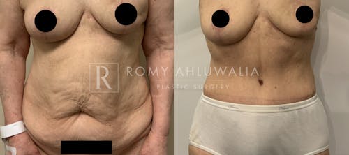 Before & After Result of Tummy Tuck Patient #53
