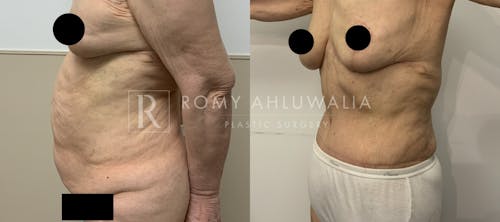 Before & After Result of Tummy Tuck Patient #53