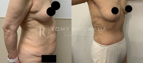 Before & After Result of Tummy Tuck Patient #53