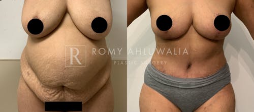 Before & After Result of Tummy Tuck Patient #1